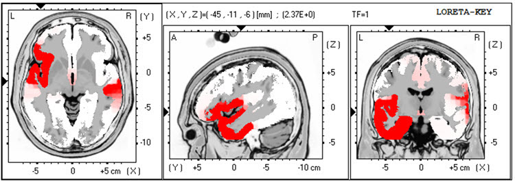 Second recording LORETA at 1 Hz showing reduced lateralization